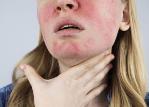 Rosacea & Redness